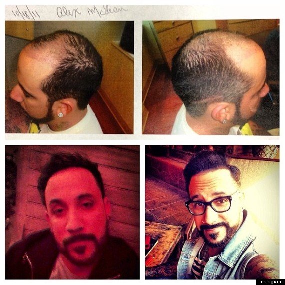 AJ McLean Hair Plugs Before and After