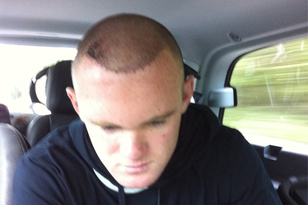 Wayne Rooney Hair Plugs