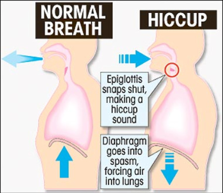 How to stop hiccups